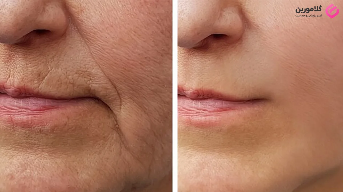 تاثیر کلاژن بر پوست